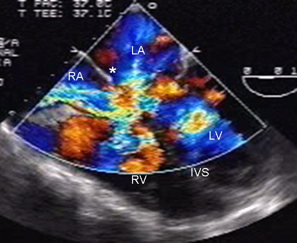 Echocardiogram